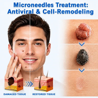 ✨Softryn®2-in-1 Microneedle & Hydrocolloid Patch🍀| Removes Raised Moles, Acne, Flat Warts & Skin Tags | Helps Improve Wrinkles, Scars & Blemishes | Invisible Patches for Face & Body