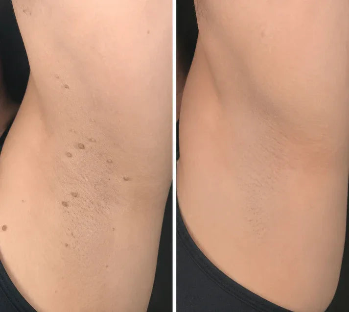 ✨Softryn®2-in-1 Microneedle & Hydrocolloid Patch🍀| Removes Raised Moles, Acne, Flat Warts & Skin Tags | Helps Improve Wrinkles, Scars & Blemishes | Invisible Patches for Face & Body